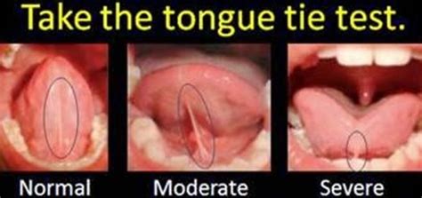 Chiropractor taree tongue tie