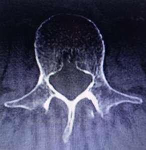 chiropractor taree scoliosis 2